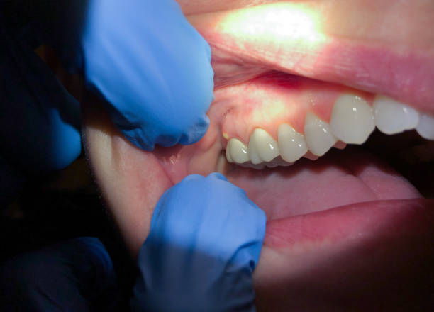 Best Emergency Broken Tooth Repair in Ramblewood, NJ