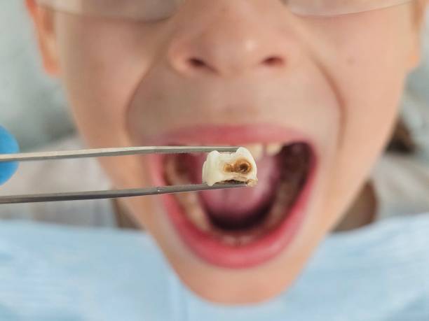 Best Emergency Tooth Extraction in Ramblewood, NJ